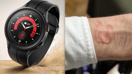 Galaxy Watch 5 Pro перегрелись ночью, разрядились и вызвали волдырь